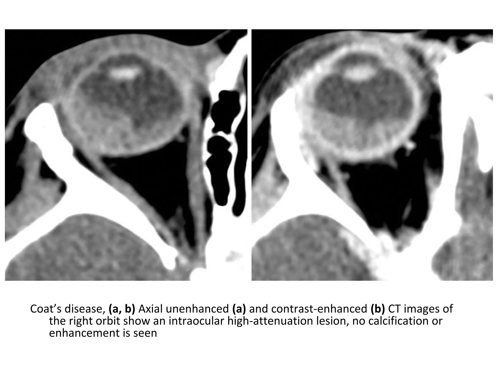 Coat’s disease, (a, b) Axial unenhanced (a) and contrast-enhanced (b) CT images of
the right orbit show an intraocular high-attenuation lesion, no calcification or
enhancement is seen
 
