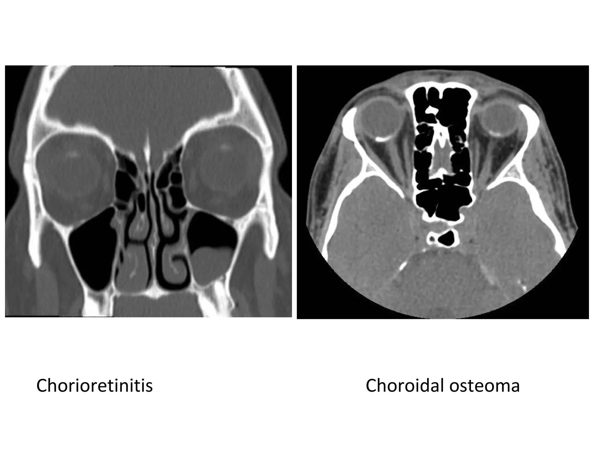 Chorioretinitis Choroidal osteoma
 