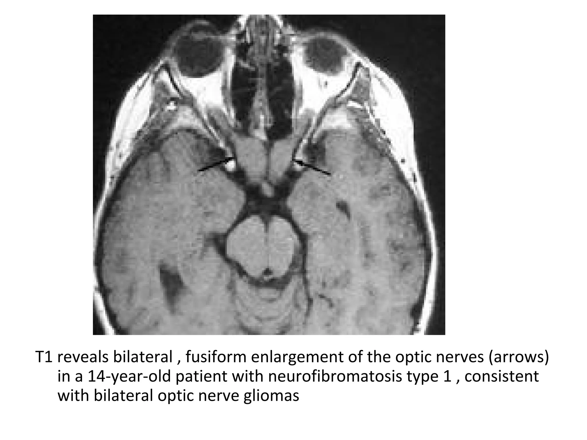 T1 reveals bilateral , fusiform enlargement of the optic nerves (arrows)
in a 14-year-old patient with neurofibromatosis type 1 , consistent
with bilateral optic nerve gliomas
 