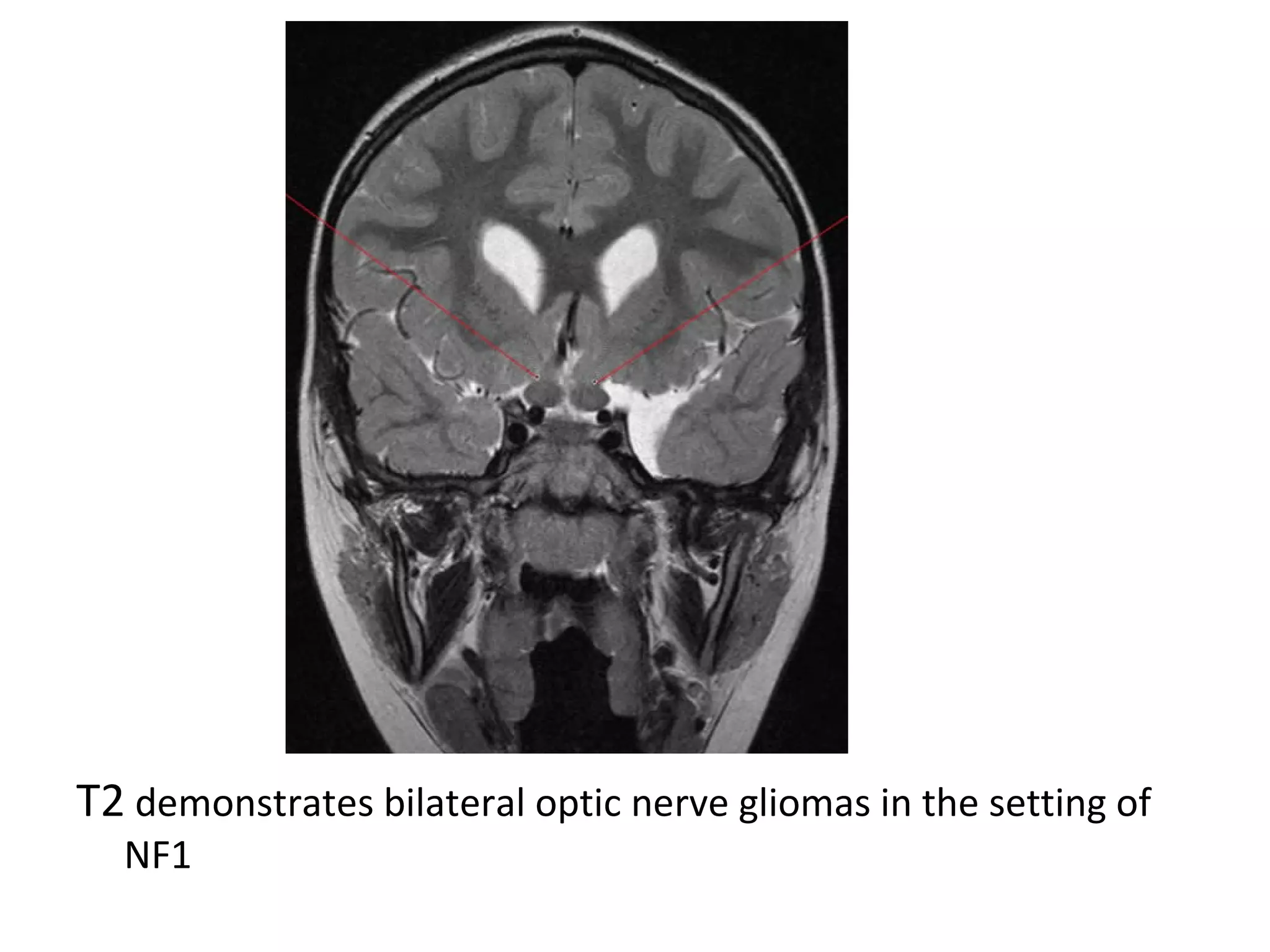 T2 demonstrates bilateral optic nerve gliomas in the setting of
NF1
 