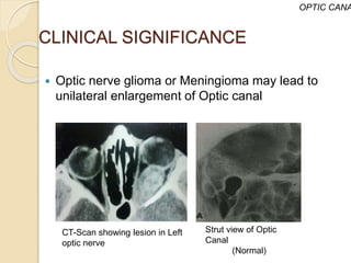 CLINICAL SIGNIFICANCE
 Optic nerve glioma or Meningioma may lead to
unilateral enlargement of Optic canal
OPTIC CANA
Strut view of Optic
Canal
(Normal)
CT-Scan showing lesion in Left
optic nerve
 