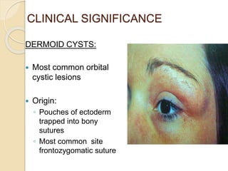 CLINICAL SIGNIFICANCE
DERMOID CYSTS:
 Most common orbital
cystic lesions
 Origin:
◦ Pouches of ectoderm
trapped into bony
sutures
◦ Most common site
frontozygomatic suture
 