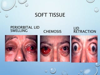 SOFT TISSUE
PERIORBITAL LID
SWELLING
LID
RETRACTIONCHEMOSIS
 