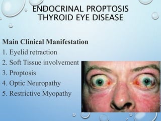 ENDOCRINAL PROPTOSIS
THYROID EYE DISEASE
Main Clinical Manifestation
1. Eyelid retraction
2. Soft Tissue involvement
3. Proptosis
4. Optic Neuropathy
5. Restrictive Myopathy
 
