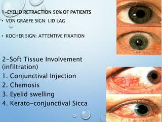 1-EYELID RETRACTION 50% OF PATIENTS
• VON GRAEFE SIGN: LID LAG
• KOCHER SIGN: ATTENTIVE FIXATION
2-Soft Tissue Involvement
(infiltration)
1. Conjunctival Injection
2. Chemosis
3. Eyelid swelling
4. Kerato-conjunctival Sicca
 