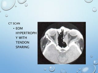 CT SCAN
• EOM
HYPERTROPH
Y WITH
TENDON
SPARING
 