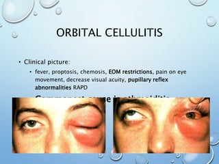 ORBITAL CELLULITIS
• Clinical picture:
• fever, proptosis, chemosis, EOM restrictions, pain on eye
movement, decrease visual acuity, pupillary reflex
abnormalities RAPD
• Commonest cause is ethmoiditis
 
