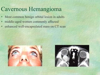 Cavernous Hemangioma
 Most common benign orbital lesion in adults
 middle-aged women commonly affected
 enhanced well-encapsulated mass on CT scan
 