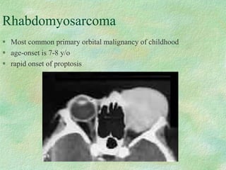 Rhabdomyosarcoma
 Most common primary orbital malignancy of childhood
 age-onset is 7-8 y/o
 rapid onset of proptosis
 