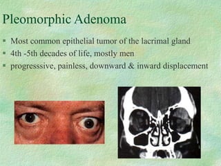 Pleomorphic Adenoma
 Most common epithelial tumor of the lacrimal gland
 4th -5th decades of life, mostly men
 progresssive, painless, downward & inward displacement
 