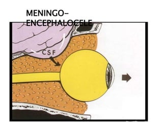 MENINGO-
ENCEPHALOCELE
 