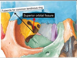 Superior orbital fissure
 