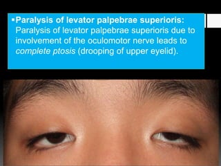 Paralysis of levator palpebrae superioris:
Paralysis of levator palpebrae superioris due to
involvement of the oculomotor nerve leads to
complete ptosis (drooping of upper eyelid).
 