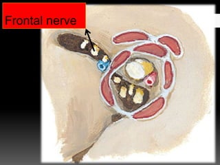 Frontal nerve
 