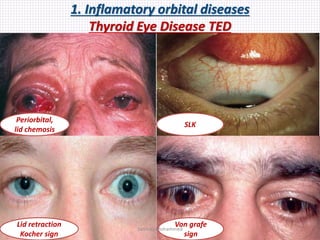 1. Inflamatory orbital diseases
Thyroid Eye Disease TED
Periorbital,
lid chemosis
SLK
Lid retraction
Kocher sign
Von grafe
sign
Samhaa Mohammed
 
