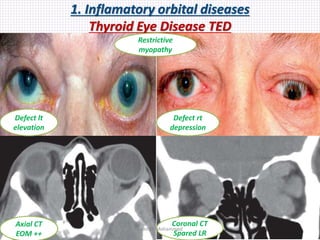 1. Inflamatory orbital diseases
Thyroid Eye Disease TED
Defect lt
elevation
Defect rt
depression
Axial CT
EOM ++
Coronal CT
Spared LR
Restrictive
myopathy
Samhaa Mohammed
 