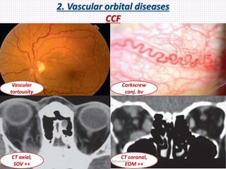 2. Vascular orbital diseases
CCF
Corkscrew
conj. bv
Vascular
tortousity
CT axial,
SOV ++
CT coronal,
EOM ++
Samhaa Mohammed
 