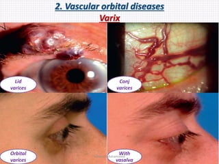 2. Vascular orbital diseases
Varix
Lid
varices
Conj
varices
Orbital
varices
With
vasalva
Samhaa Mohammed
 