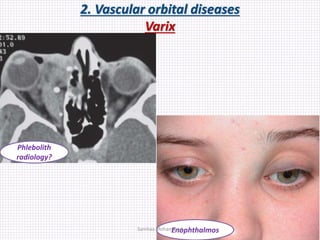 2. Vascular orbital diseases
Varix
Enophthalmos
Phlebolith
radiology?
Samhaa Mohammed
 
