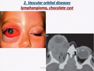 2. Vascular orbital diseases
lymphangioma, chocolate cyst
Samhaa Mohammed
 