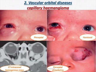 2. Vascular orbital diseases
capillary haemangioma
Preseptal Forniceal
CT intraconal
homogenous mass
Preseptal
strawbelrry
Samhaa Mohammed
 