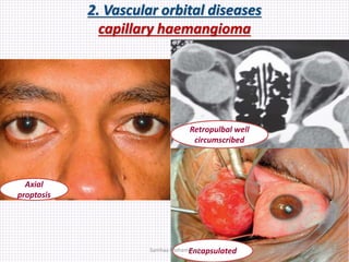 2. Vascular orbital diseases
capillary haemangioma
Axial
proptosis
Retropulbal well
circumscribed
EncapsulatedSamhaa Mohammed
 