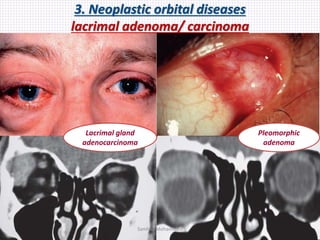 3. Neoplastic orbital diseases
lacrimal adenoma/ carcinoma
Lacrimal gland
adenocarcinoma
Pleomorphic
adenoma
Samhaa Mohammed
 