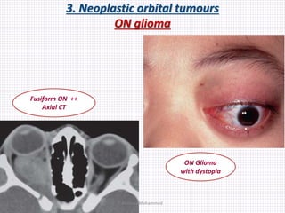 3. Neoplastic orbital tumours
ON glioma
Fusiform ON ++
Axial CT
ON Glioma
with dystopia
Samhaa Mohammed
 