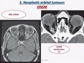 3. Neoplastic orbital tumours
ONSM
MRI, ONSM
ONSM
calcification,
CT
Samhaa Mohammed
 