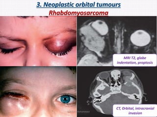 3. Neoplastic orbital tumours
Rhabdomyosarcoma
MRI T2, globe
indentation, proptosis
CT, Orbital, intracranial
invasionSamhaa Mohammed
 