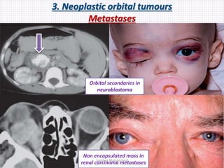 3. Neoplastic orbital tumours
Metastases
Non encapsulated mass in
renal carcinoma metastases
Orbital secondaries in
neuroblastoma
Samhaa Mohammed
 