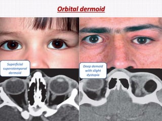 Orbital dermoid
Samhaa Mohammed
Deep demoid
with slight
dystopia
Superficial
superotemporal
dermoid
 