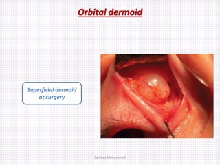 Orbital dermoid
Samhaa Mohammed
Superficial dermoid
at surgery
 