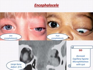 Encephalocele
Samhaa Mohammed
Post
encephalocele
Ant
encephaloocele
Large bony
defect (CT)
DD
Dermoid
Capillary hgoma
Microphthalmos
with cyst
 