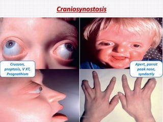 Craniosynostosis
Apert, parrot
peak nose,
syndactly
Cruozon,
proptosis, V XT,
Prognathism
Samhaa Mohammed
 