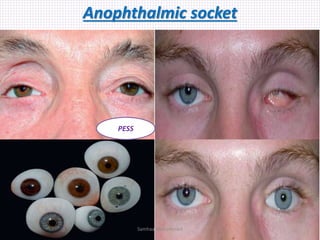 Anophthalmic socket
PESS
Samhaa Mohammed
 