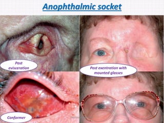 Anophthalmic socket
Post
evisceration
Conformer
Post exentration with
mounted glasses
Samhaa Mohammed
 