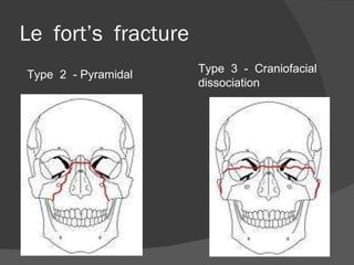 Le  fort’s  fracture Type  2  - Pyramidal Type  3  -  Craniofacial  dissociation 