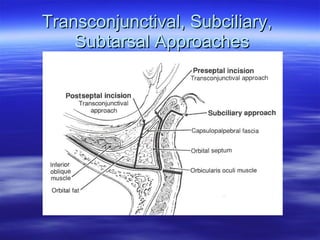 Subciliary Ridge Orbit Floor Fx Slides | PPT