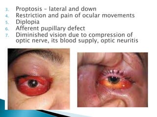 3. Proptosis – lateral and down 
4. Restriction and pain of ocular movements 
5. Diplopia 
6. Afferent pupillary defect 
7. Diminished vision due to compression of 
optic nerve, its blood supply, optic neuritis 
 