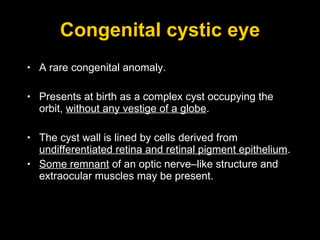 Congenital cystic eye A rare congenital anomaly. Presents at birth as a complex cyst occupying the orbit,  without any vestige of a globe .  The cyst wall is lined by cells derived from  undifferentiated retina and retinal pigment epithelium .  Some remnant  of an optic nerve–like structure and extraocular muscles may be present. 