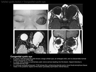 Orbital cystic lesion > Congenital cystic eye Congenital cystic eye B, Axial T1WI through the orbit shows a large orbital cyst, an enlarged orbit, and no discernible normal bulbar structures on the left.  C, Axial T2WI shows a rudimentary optic nerve (arrow) leading into the lesion. Signal intensity is homogeneously high.  D, Coronal contrast-enhanced, T1WI shows thin, enhancing strands and a more focal amorphous tissue mass in the posterior aspect of the lesion (probably dysmorphic retinal tissue). 