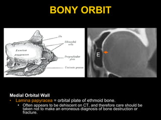 BONY ORBIT Medial Orbital Wall Lamina papyracea  = orbital plate of ethmoid bone. Often appears to be dehiscent on CT, and therefore care should be taken not to make an erroneous diagnosis of bone destruction or fracture. 