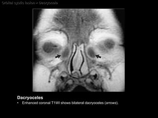 Orbital cystic lesion > Dacryocele Dacryoceles Enhanced coronal T1WI shows bilateral dacryoceles ( arrows ). 