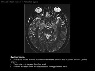 Orbital cystic lesion > Parasitic cysts  Cysticercosis.   Axial T2WI shows multiple intracranial abscesses (arrows) and an orbital abscess (hollow arrow).  The orbital cyst shows a fluid-fluid level.  Scolices are seen within the abscesses as tiny hypointense areas. 