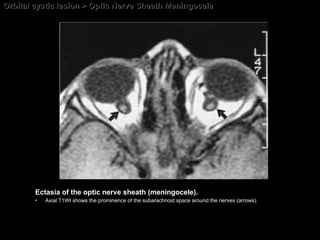 Orbital cystic lesion > Optic Nerve Sheath Meningocele Ectasia of the optic nerve sheath (meningocele).  Axial T1WI shows the prominence of the subarachnoid space around the nerves (arrows). 