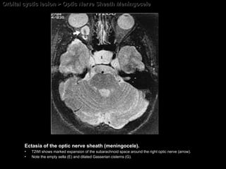 Orbital cystic lesion > Optic Nerve Sheath Meningocele Ectasia of the optic nerve sheath (meningocele).  T2WI shows marked expansion of the subarachnoid space around the right optic nerve (arrow).  Note the empty sella (E) and dilated Gasserian cisterns (G). 