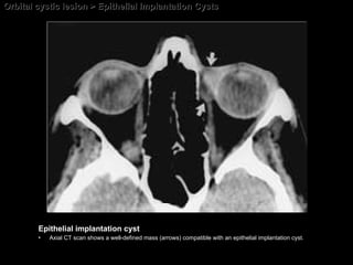 Orbital cystic lesion > Epithelial Implantation Cysts Epithelial implantation cyst Axial CT scan shows a well-defined mass (arrows) compatible with an epithelial implantation cyst. 