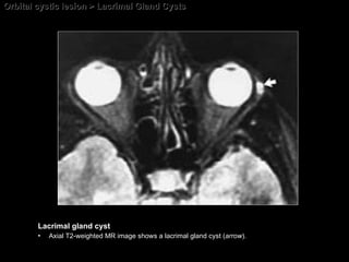 Orbital cystic lesion > Lacrimal Gland Cysts Lacrimal gland cyst Axial T2-weighted MR image shows a lacrimal gland cyst ( arrow ). 
