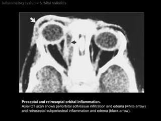 Inflammatory lesion > Orbital cellulitis Preseptal and retroseptal orbital inflammation.  Axial CT scan shows periorbital soft-tissue infiltration and edema (white arrow) and retroseptal subperiosteal inflammation and edema (black arrow). 